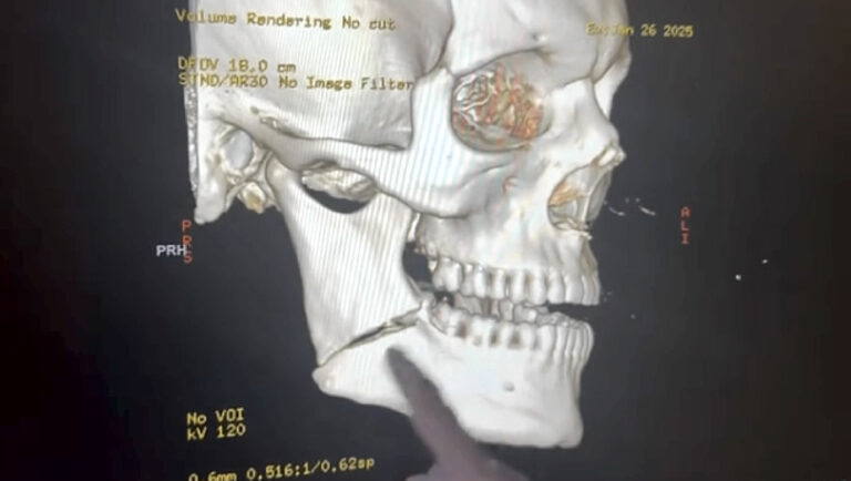 Eddie Alvarez shares x-ray of broken jaw suffered