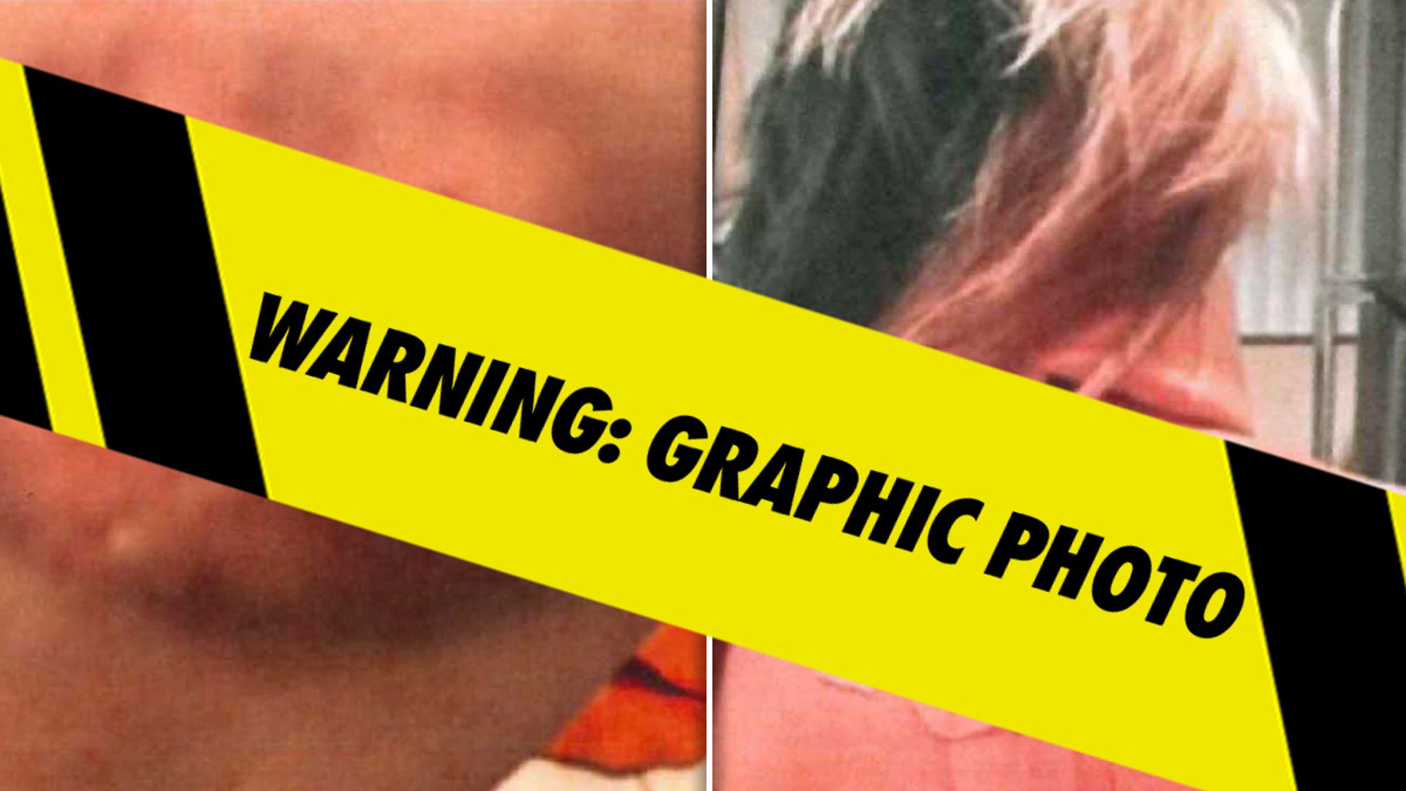 Bryana Bongolan's Alleged Injury Photos From