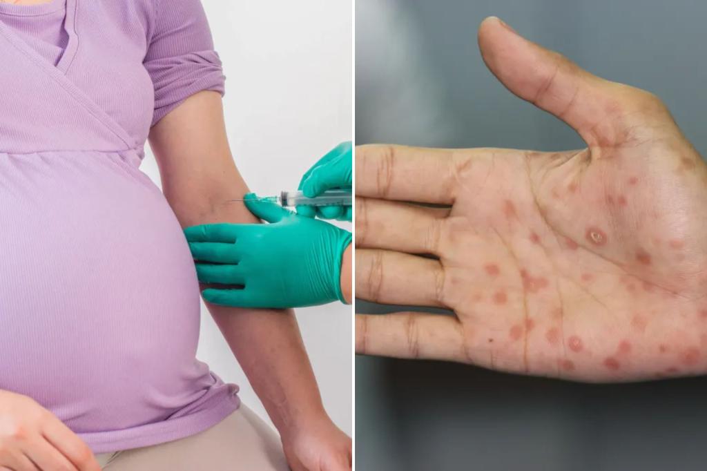 3 babies die amid 'concerning rise' of syphilis in | Lifestyle News