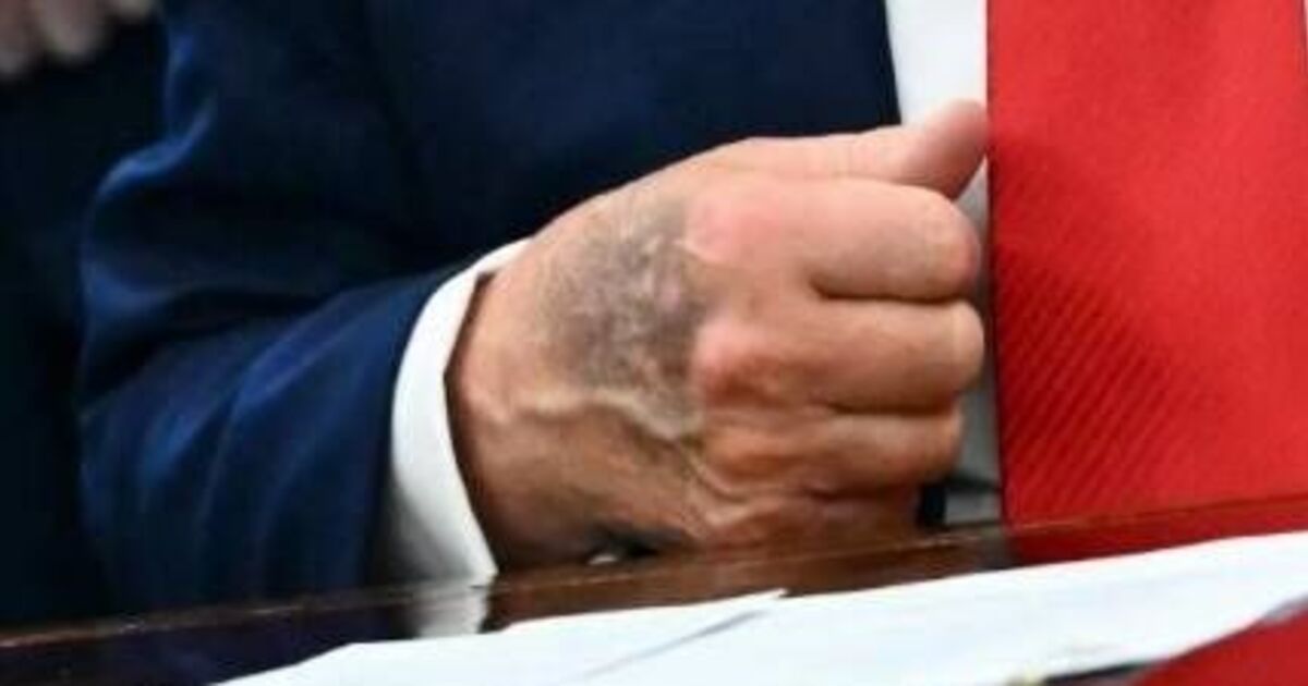 Donald Trump's badly bruised hand in Oval Office | Political News