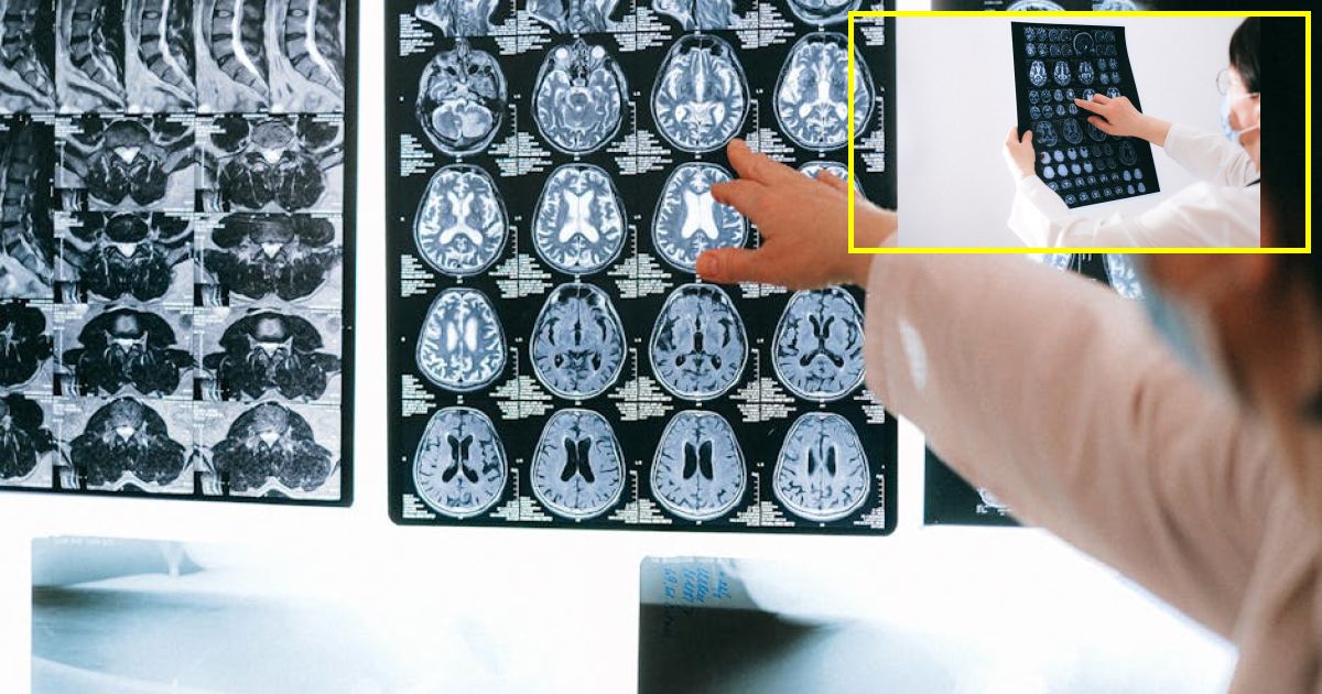 New MRI brain scan can predict Alzheimers before symptoms develop