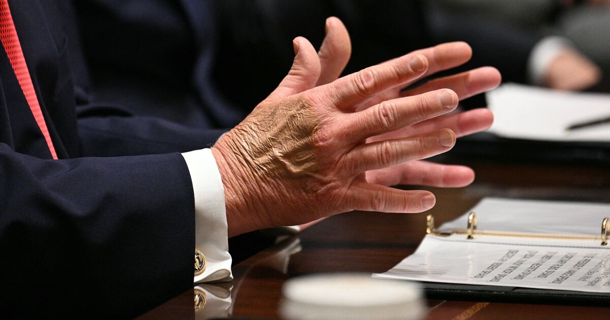 Trump spotted with 2 fresh bruises on both hands | Political News