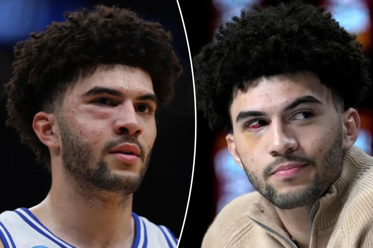 Cameron Boozer suffered multiple facial fractures | Sports News