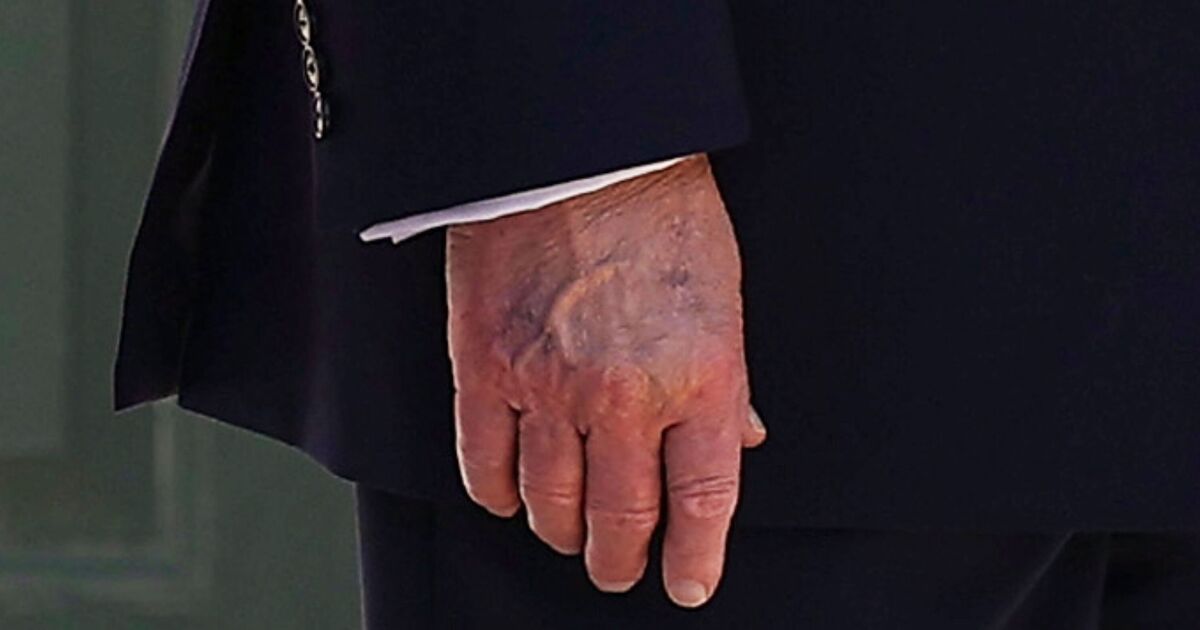 Trumps hand appears swollen and discolored after